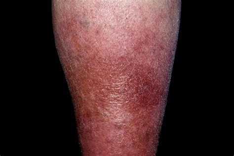 under the skin hot|Burning Legs: Symptoms, Causes, and Treatments.